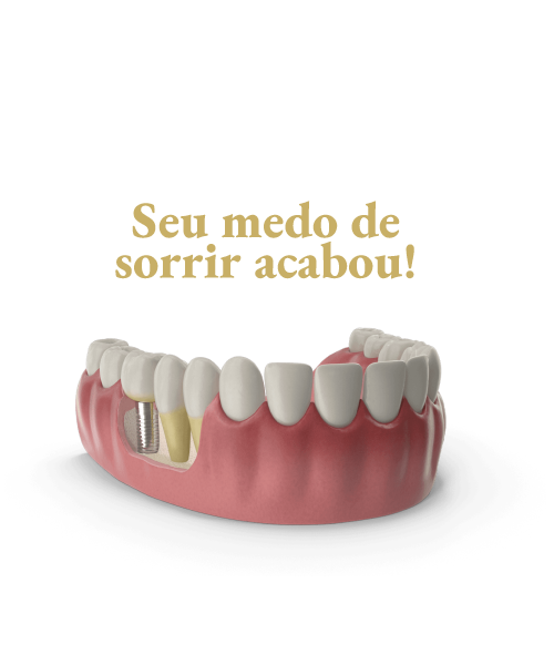 Implentes Dentários